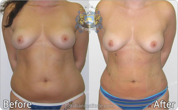 ba-gallery bodylipo1-1