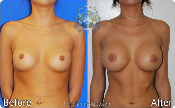 Breast Augmentation